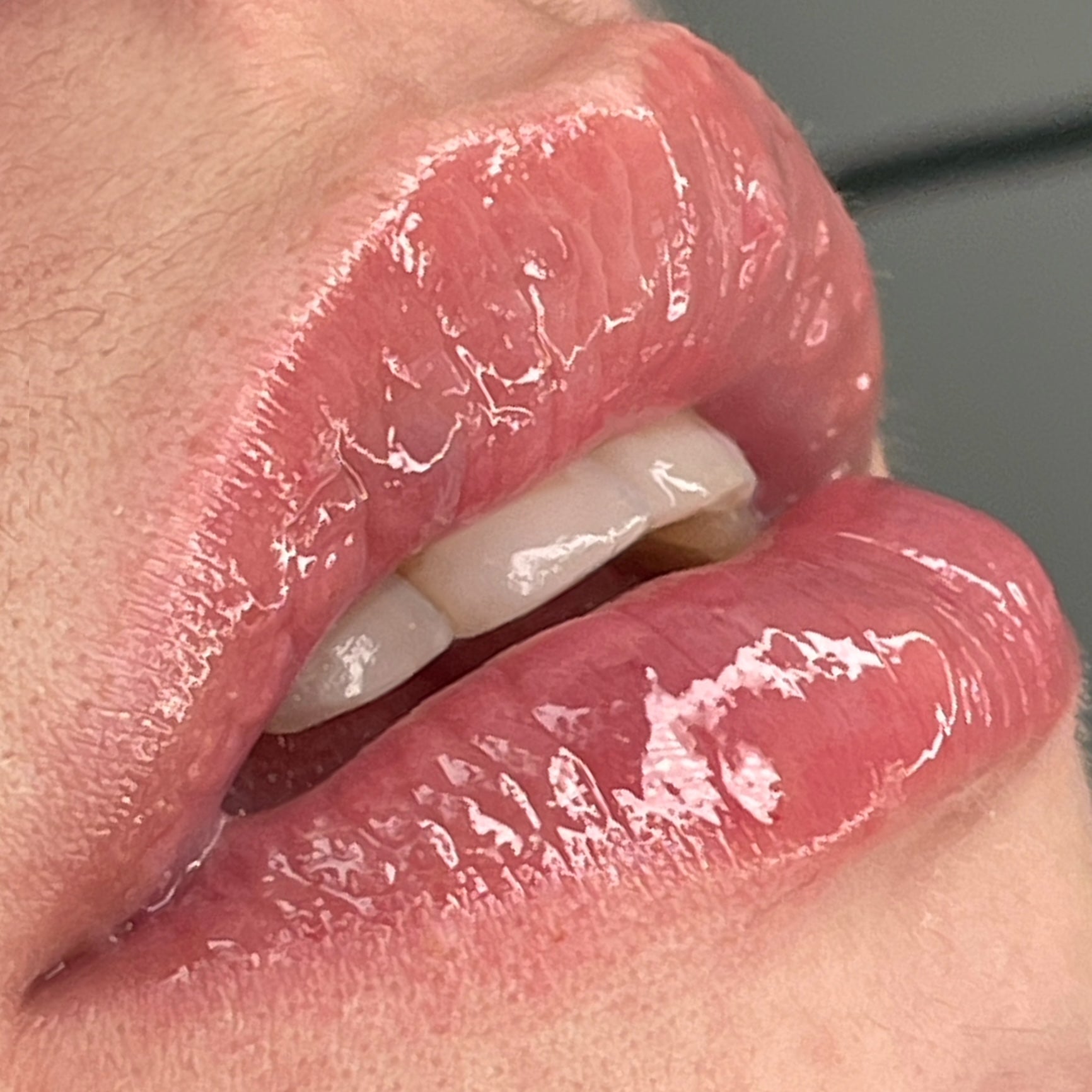 Videocorso Hyaluron Pen – Filler senza ago