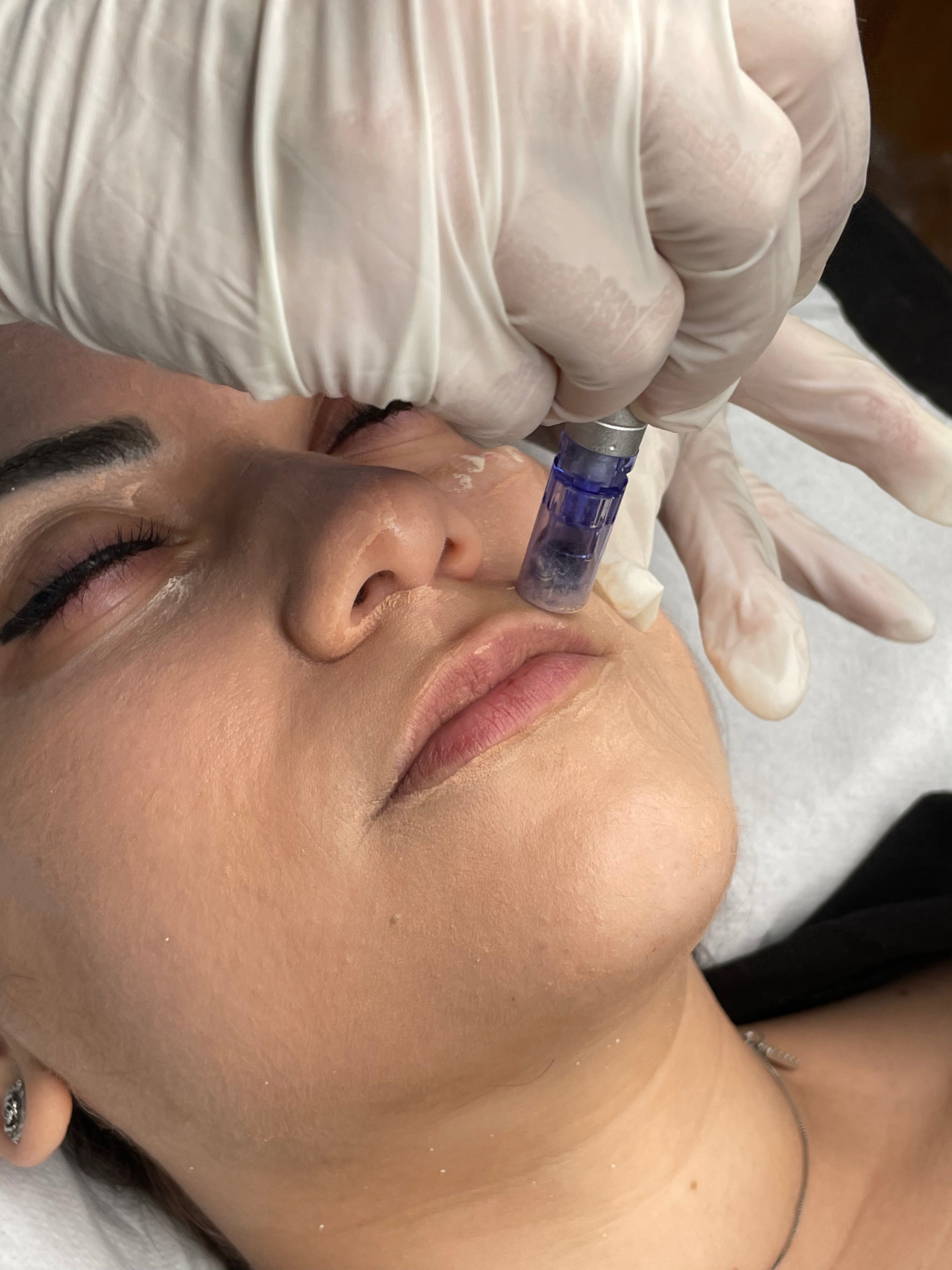 Corso BBGLOW & MICRONEEDLING